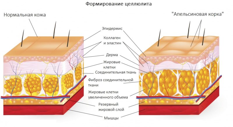 Апельсиновая корка на коже фото