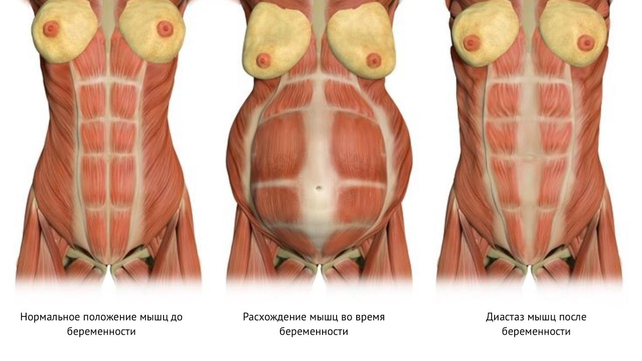 Мышцы живота после беременности. Диастаз мышц белой линии живота. Диастаз прямой мышцы живота. Диастаз прямых мышц живота 2 степени.